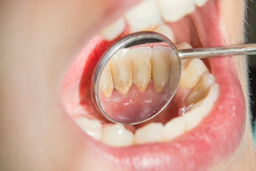 Tak Perlu Ke Dokter Gigi, Ini 4  Cara Menghilangkan Karang Gigi Secara Alami Sendiri di Rumah