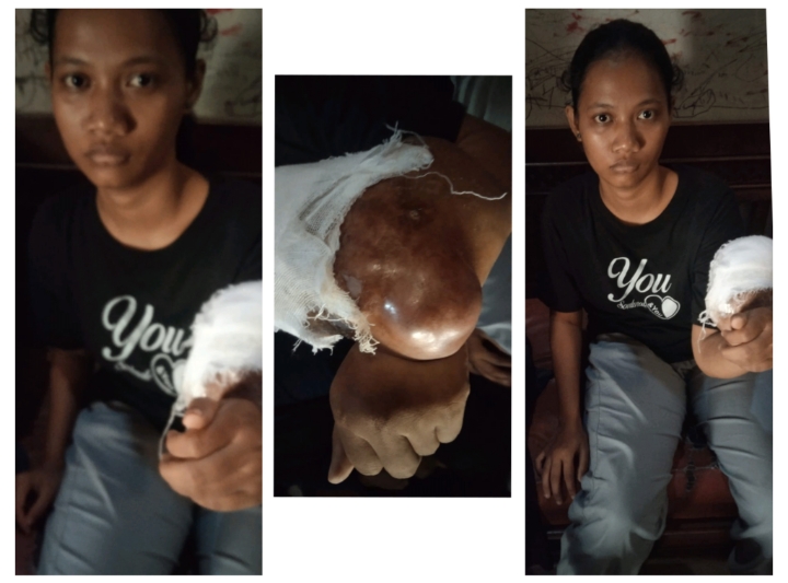 Perempuan Ini Derita Kanker Tulang Sejak 2023, Begini Kisahnya 