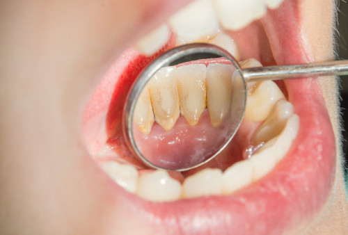 Tak Perlu Ke Dokter Gigi, Ini 4  Cara Menghilangkan Karang Gigi Secara Alami Sendiri di Rumah