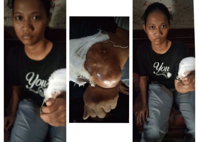 Perempuan Ini Derita Kanker Tulang Sejak 2023, Begini Kisahnya 